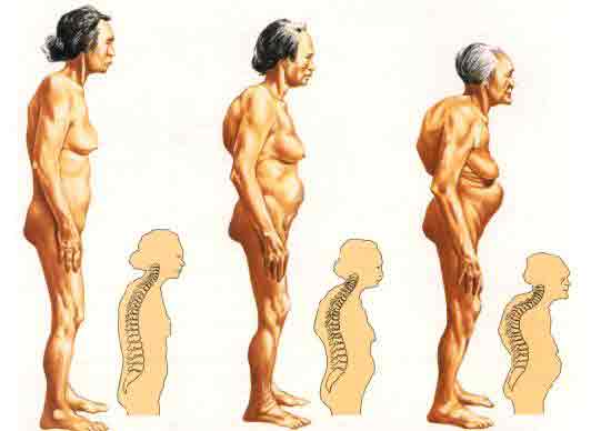 写真：骨密度対策